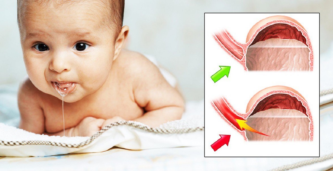 Tác động của trào ngược dạ dày đối với sức khỏe và phát triển của trẻ sơ sinh?
