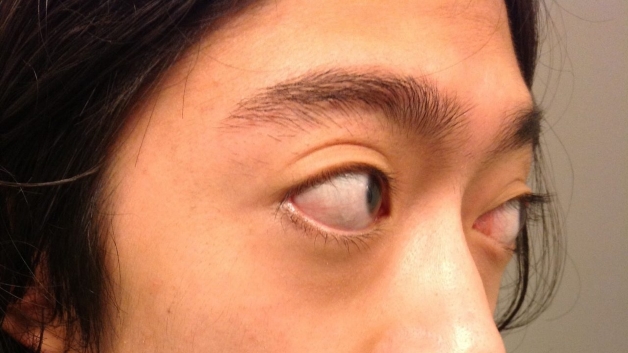 u hạt hốc mắt
