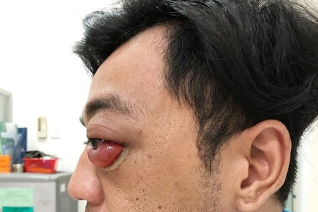 u hạt hốc mắt