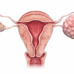 Phụ nữ bị u nang buồng trứng có thai được không?
