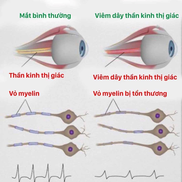 viêm thị thần kinh cấp