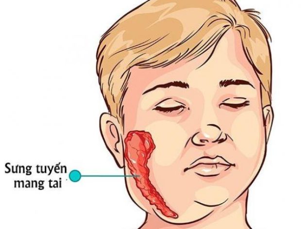 Trẻ sưng tuyến nước bọt mang tai vì quai bị