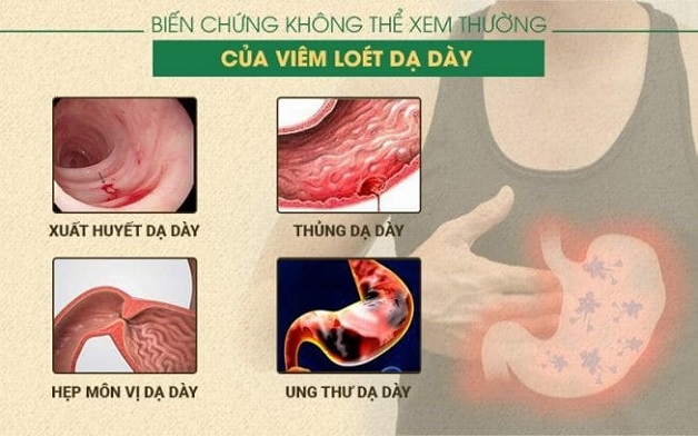 cach chua viem da day ta trang 2