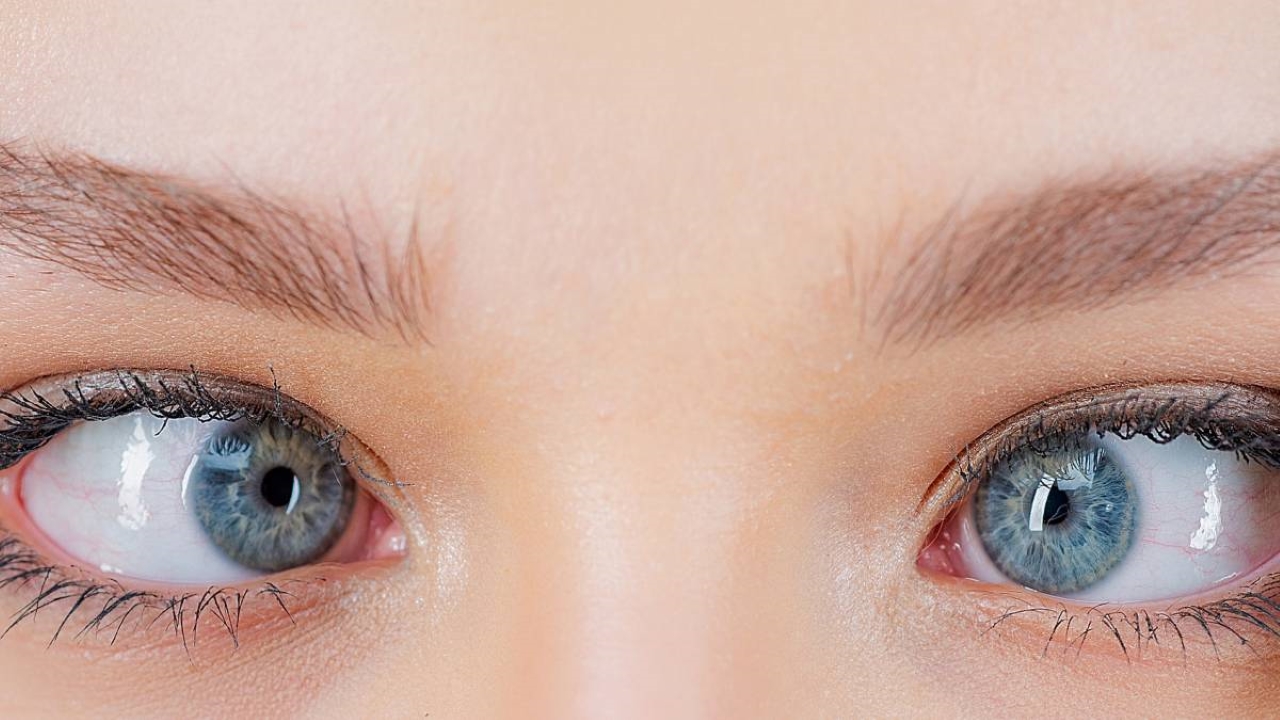 Mắt lác ở trẻ em có thể tự khỏi được không?

