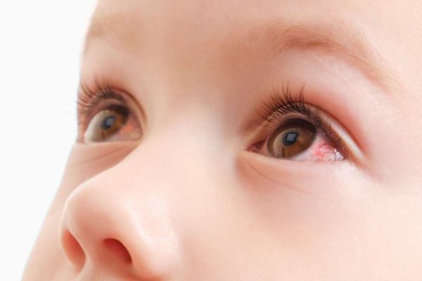 Đau mắt đỏ là tình trạng viêm nhiễm ở vùng kết mạc mắt