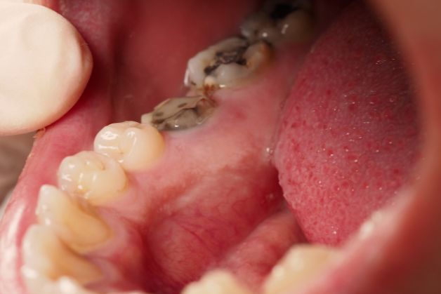 Cách điều trị răng sâu nhanh chóng, an toàn