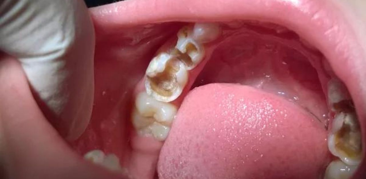 Tình trạng sâu răng ở trẻ em 4 tuổi cần được trám ngay không?

