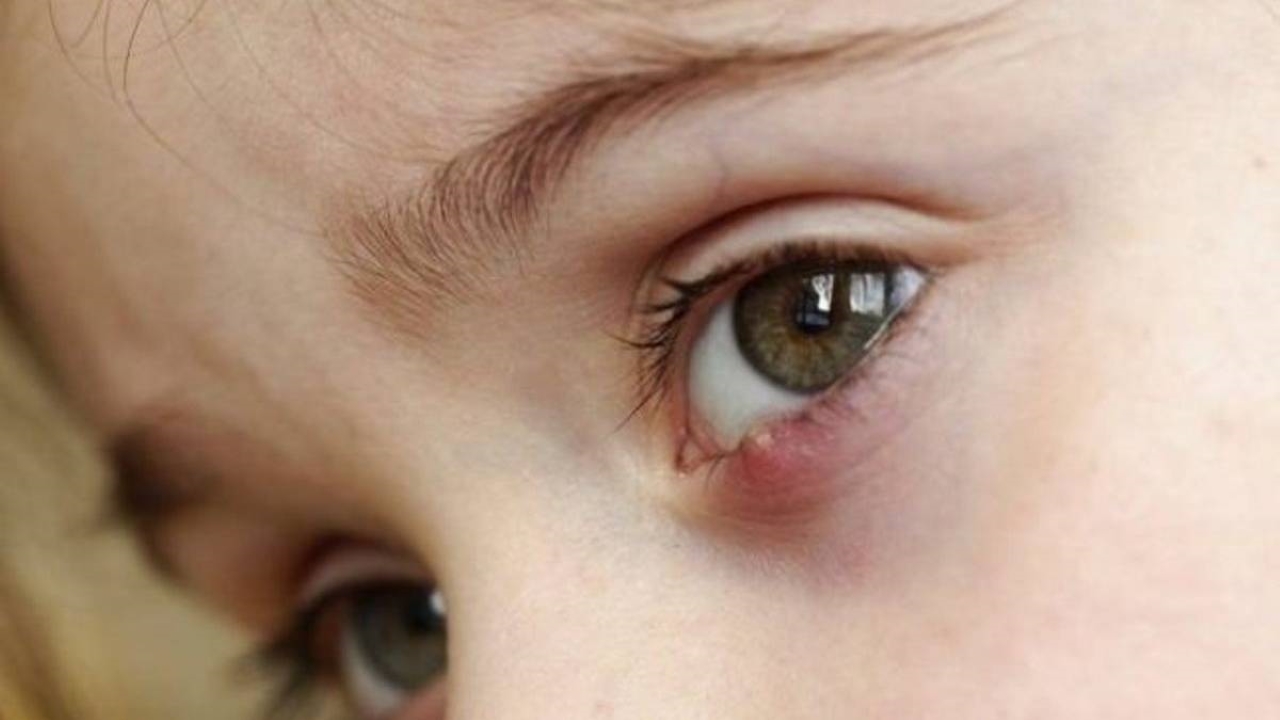  Cách chữa chắp mắt tại nhà : Bí quyết giảm đau và sưng tại nhà