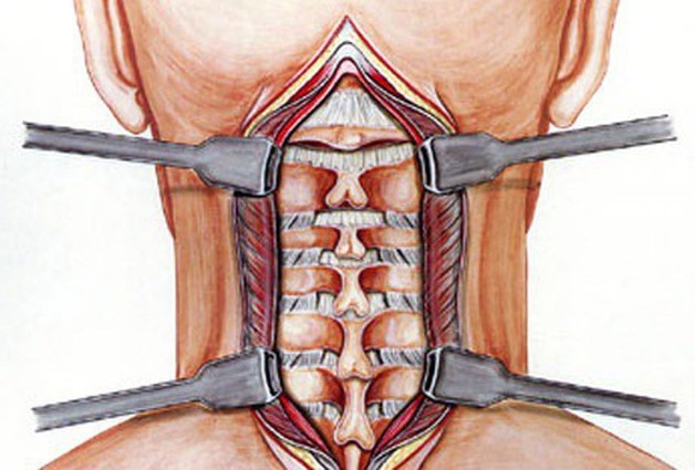 Vôi đốt sống cổ thường xảy ra ở 3 đốt C4-C5 và C6