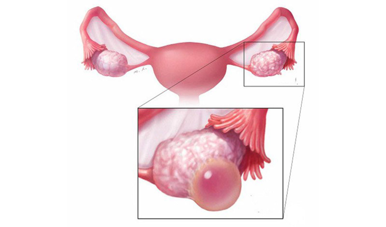 Triệu chứng của u nước là gì?
