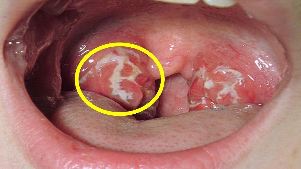 Ung thư vòm họng có liên quan đến vi-rút HPV không?
