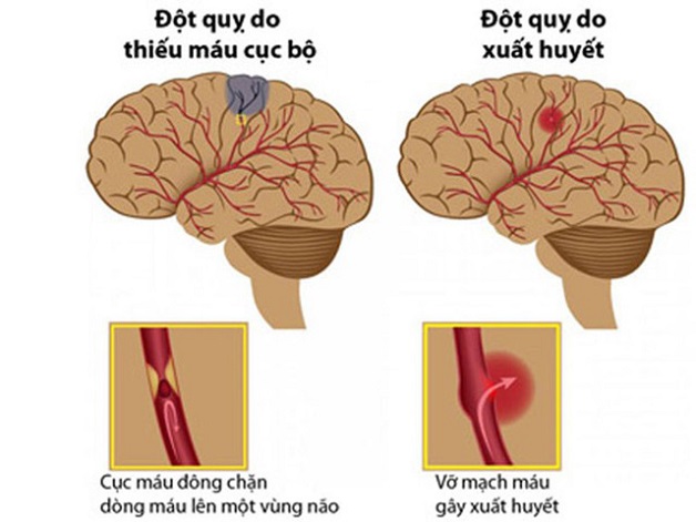 Đau đầu vận mạch là gì? Tìm hiểu nguyên nhân, triệu chứng và cách điều trị hiệu quả