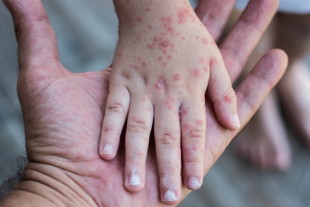 Tác dụng phụ của tiêm phòng sởi quai bị rubella: Những điều cần biết để bảo vệ sức khỏe