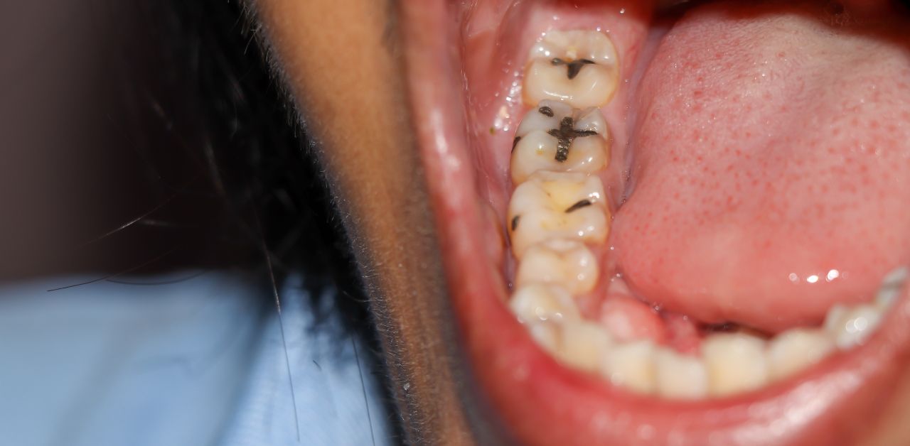 What are the risks of untreated decay and fracture in tooth number 7?