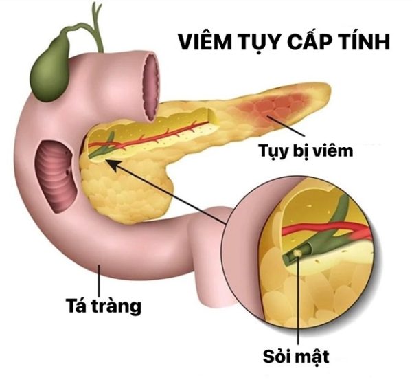 Tại sao uống rượu gây viêm tụy cấp? | TCI Hospital