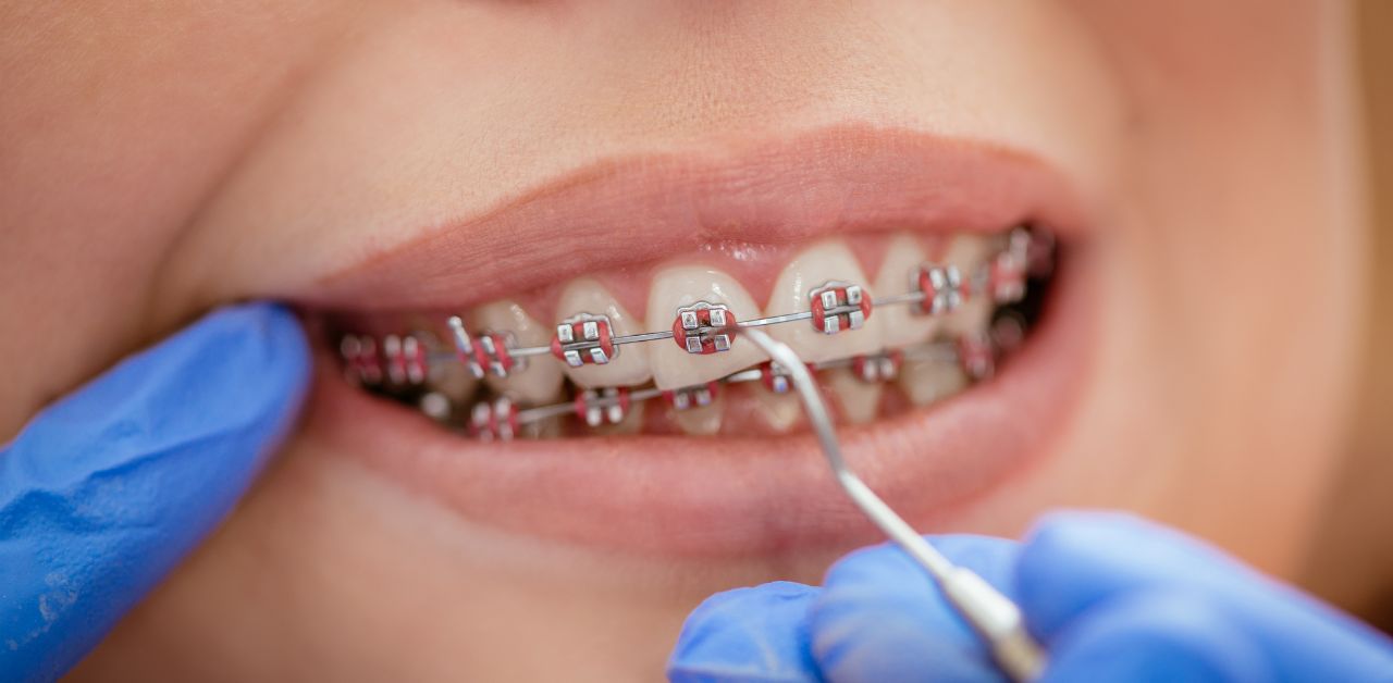 Diễn biến của sâu răng khi niềng răng như thế nào?
