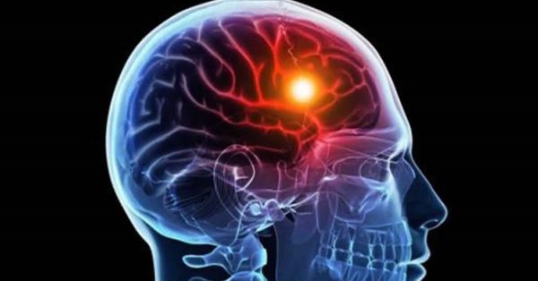 Triệu chứng của bệnh Azeihemer Những dấu hiệu cảnh báo về sự suy giảm trí nhớ