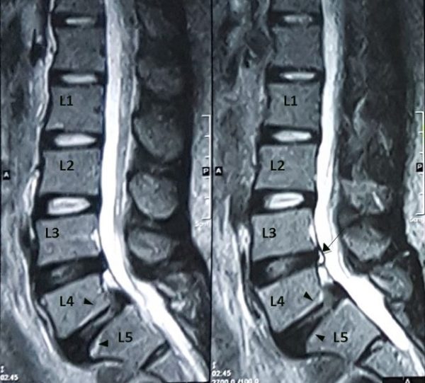 Tổn thương thoát vị đĩa đệm thoái hóa cột sống cần phải được bác sĩ chuyên khoa thăm khám và điều trị