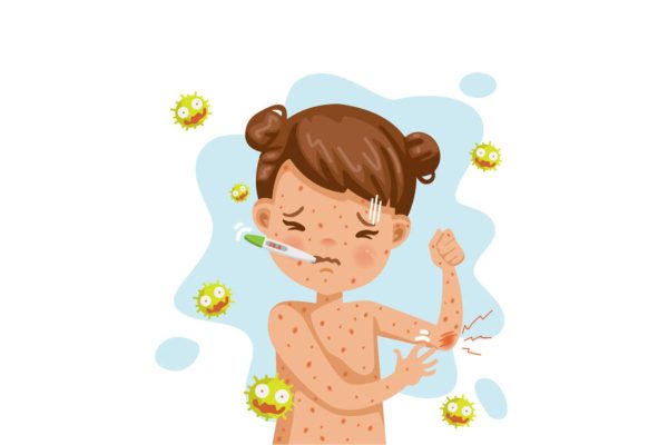 Triệu chứng bị thủy đậu ở trẻ em thường thấy là các nốt phỏng nước trên da kèm sốt cao, viêm họng...