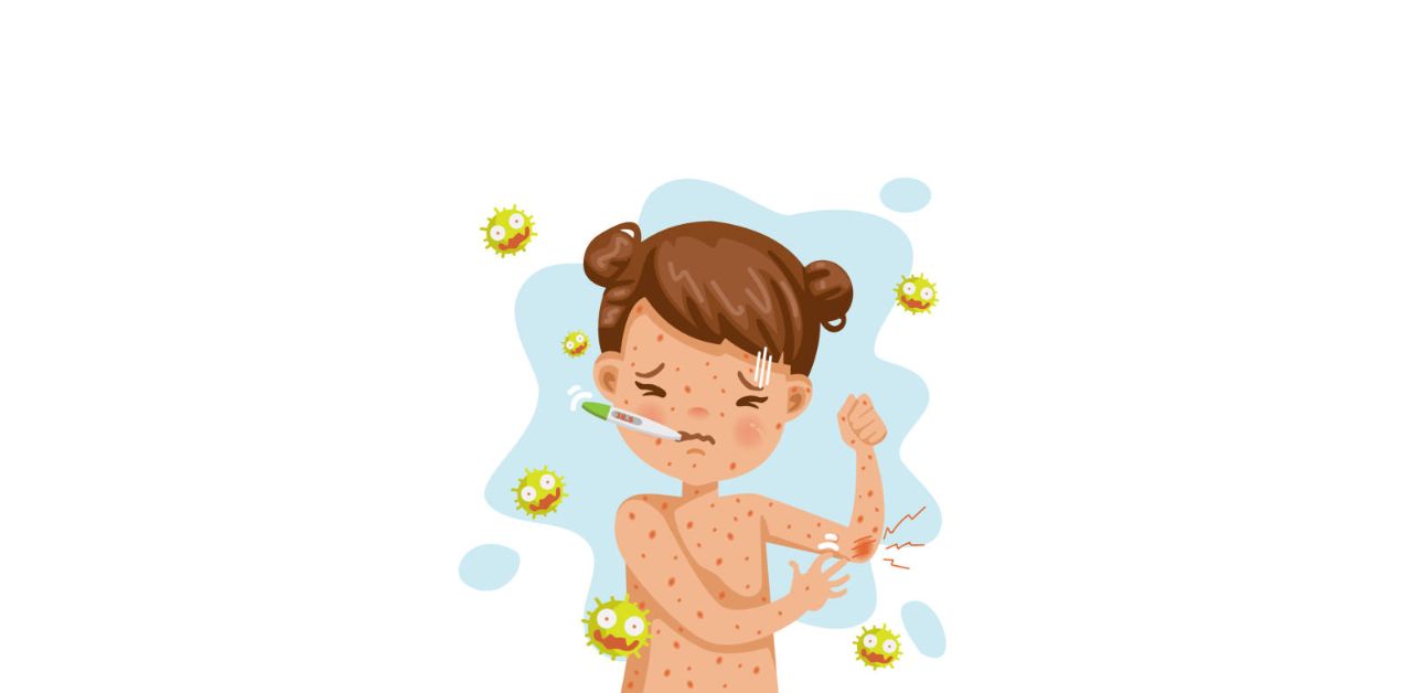 Nhận biết triệu chứng bị thủy đậu ở trẻ em