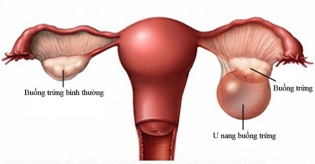U nang buồng trứng hay còn được gọi là bao nang