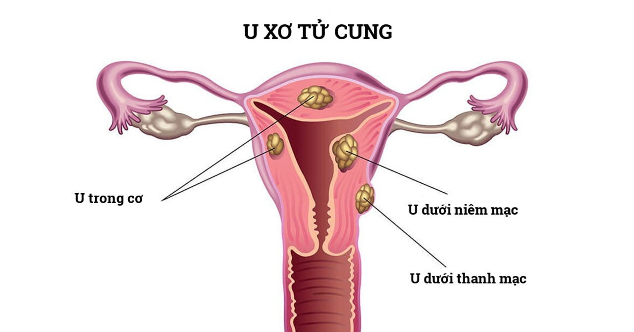 Tử cung có thể di chuyển ra khỏi vị trí bình thường không?
