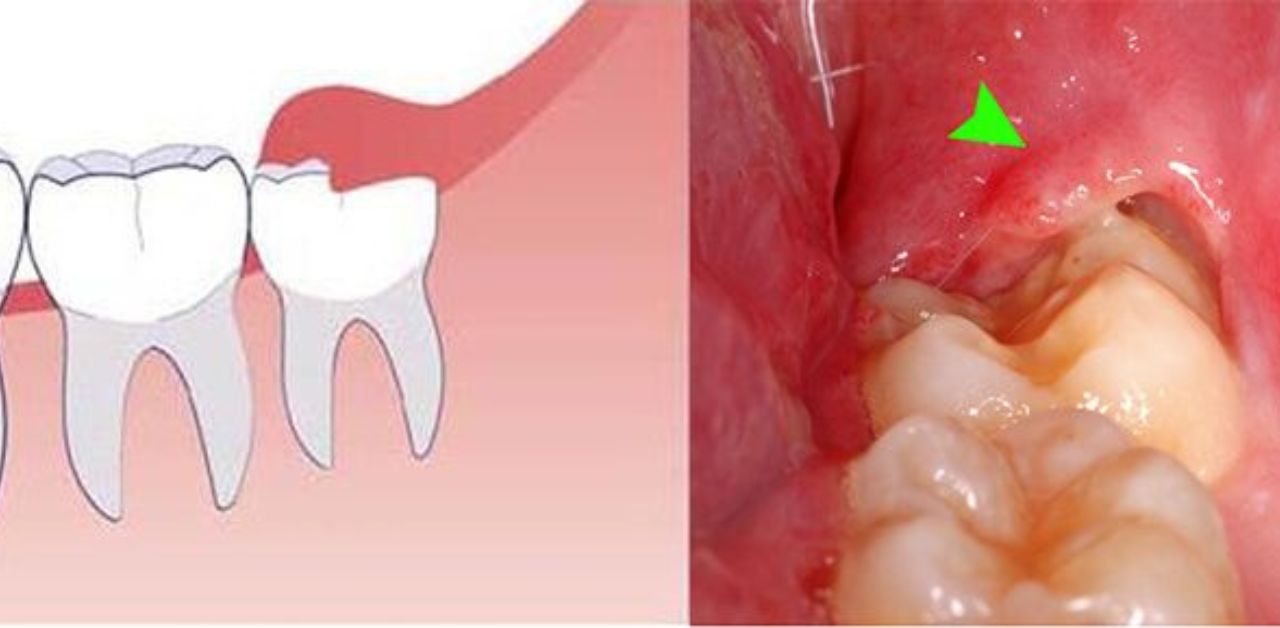 Thuốc và phương pháp điều trị viêm lợi trùm ở trẻ em là gì?
