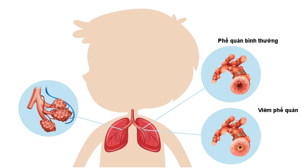 1. Tổng Quan Về Viêm Phế Quản Bội Nhiễm