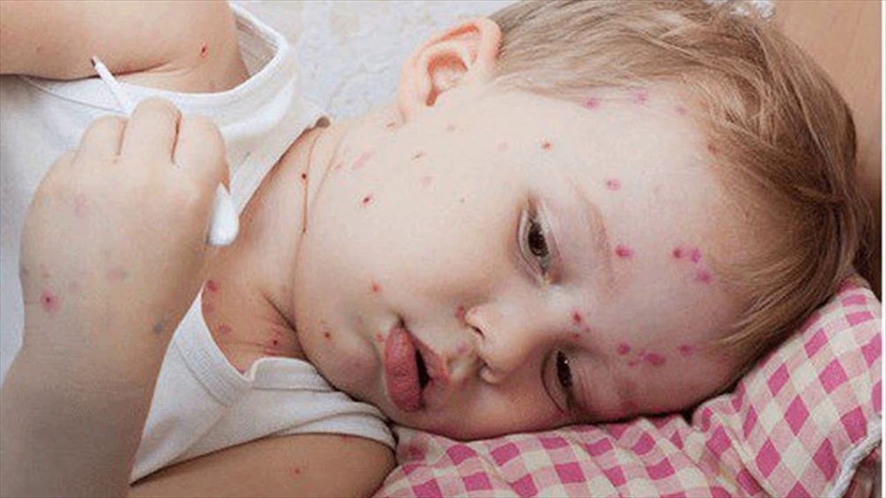 Mẹo vặt chăm sóc bệnh thủy đậu ở trẻ em nên kiêng gì để giảm thiểu tác hại