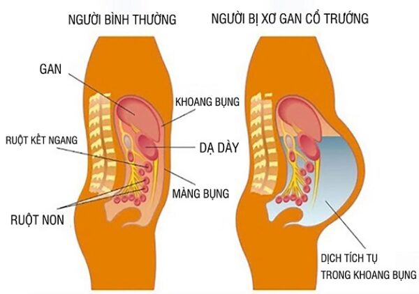 Biến Chứng Của Viêm Gan