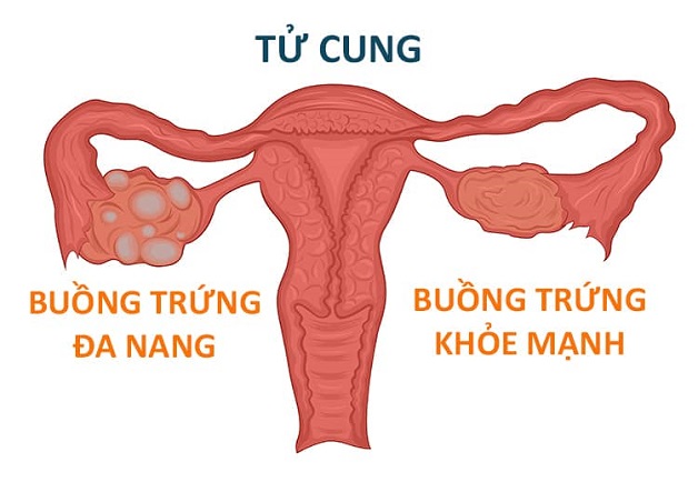 U Nang Đa Thùy Buồng Trứng