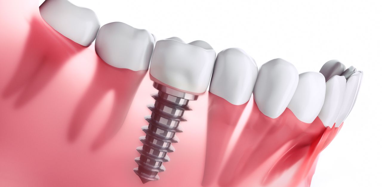 Có những biến chứng hoặc rủi ro nào trong quá trình trồng răng implant?
