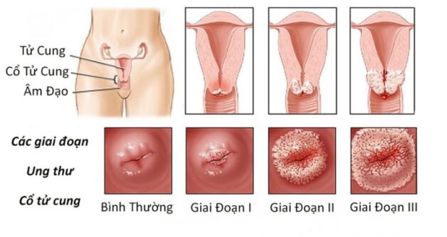 Dấu hiệu giúp phát hiện ung thư cổ tử cung | TCI Hospital