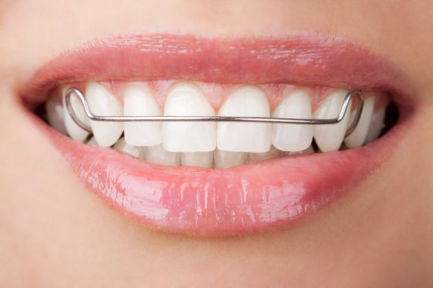 Tại sao lại bị ê răng khi đeo hàm duy trì?
