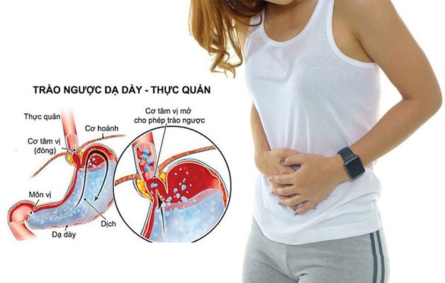 K21 Bệnh Trào Ngược Dạ Dày: Nguyên Nhân, Triệu Chứng và Cách Điều Trị