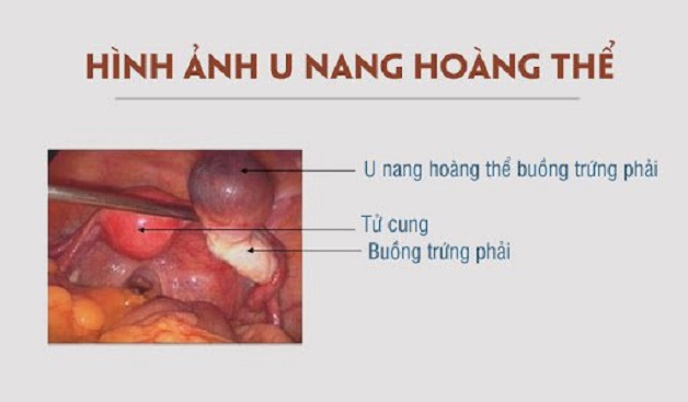 Nếu nang hoàng thể bị vỡ thì sẽ gây những cơn đau dữ dội ở vùng bụng