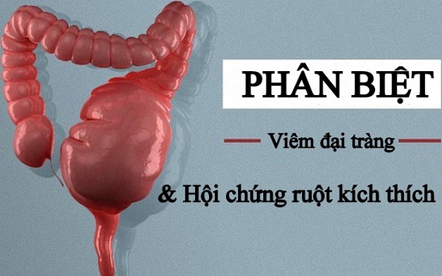 phan biet viem dai trang va hoi chung ruot kich thich