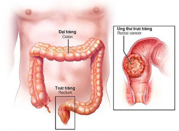ung thư trực tràng