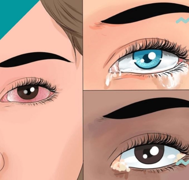 viêm kết giác mạc mùa xuân điều trị ra sao