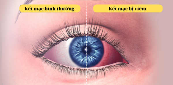 Viêm kết mạc là gì và những kiến thức cần nắm