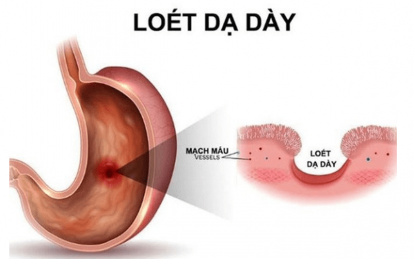 viem loet da day min 600x376 1