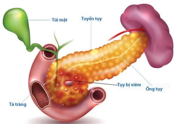 Viêm tụy cấp có dẫn tới tử vong? | TCI Hospital