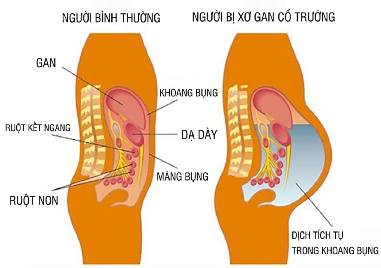 3. Triệu chứng của bệnh xơ gan bụng to