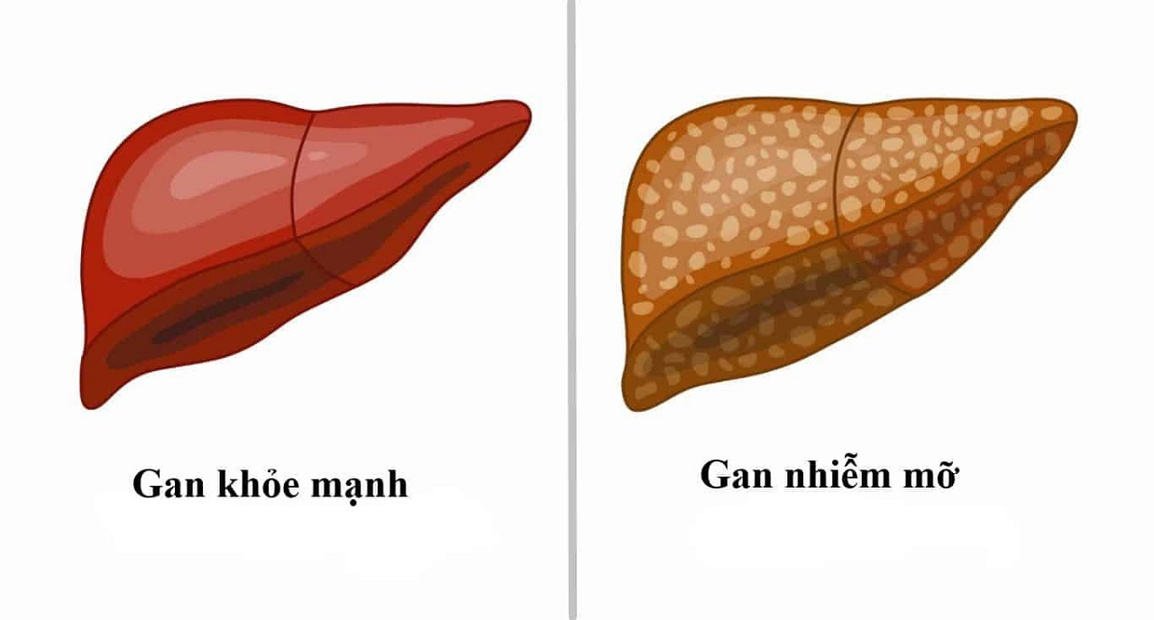 Mật độ chất béo tích tụ trên gan ở mức độ 1 chiếm khoảng bao nhiêu phần trăm? (trả lời: 5-10%)
