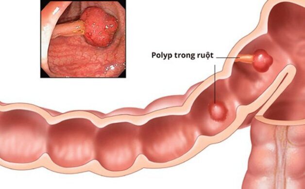 Hình ảnh Polyp đại tràng trong ruột