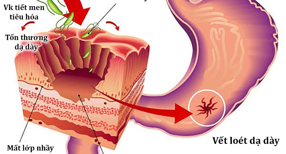 Vi khuẩn HP có thể tái phát sau khi đã được chữa trị tại nhà không?
