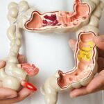 7 biến chứng bệnh Crohn và lưu ý