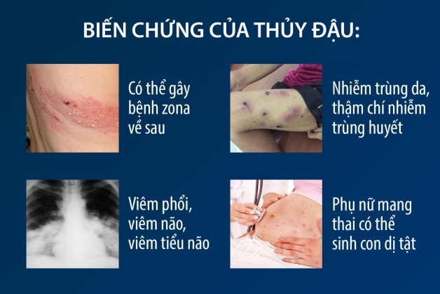 bệnh thủy đậu