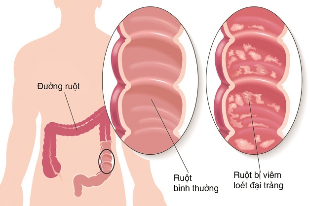 bieu hien viem loet dai trang 2