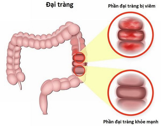 Đại Tràng Có Vấn Đề: Giải Quyết Hiệu Quả Để Cải Thiện Sức Khỏe